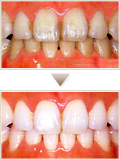 ホワイトニング